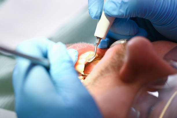 Best Emergency Tooth Extraction in Lake Forest, CA