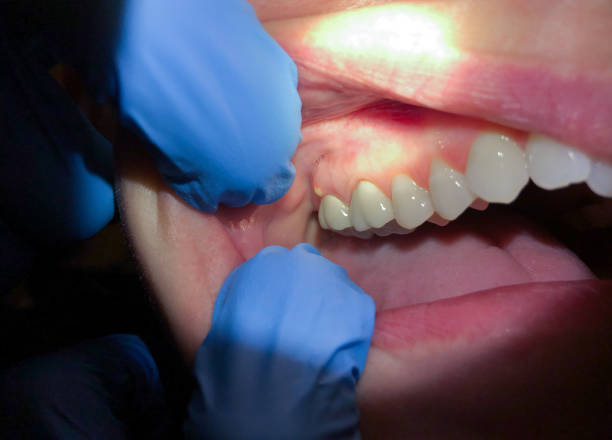 Best Emergency Treatment for Dental Infections or Abscesses in Lake Forest, CA